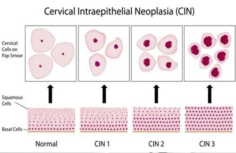 CIN1 CIN2 CIN3 Op.Dr Emrah Kızıldağ Kadın Hastalıkları ve Doğum Uzmanı Türkiye'nin En İyi Kadın Doğum Doktoru yorumları Şişli İstanbul